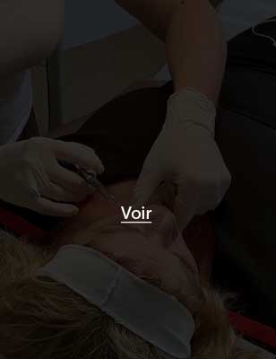 Injection d'acide hyaluronique pour les rides à Compiègne - Dr Laurence Barry