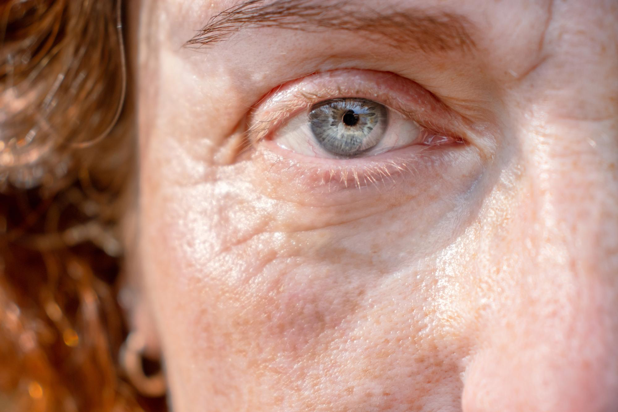 injection-acide-hyaluronique-cernes-creux-oise-compiegne-dr-barry