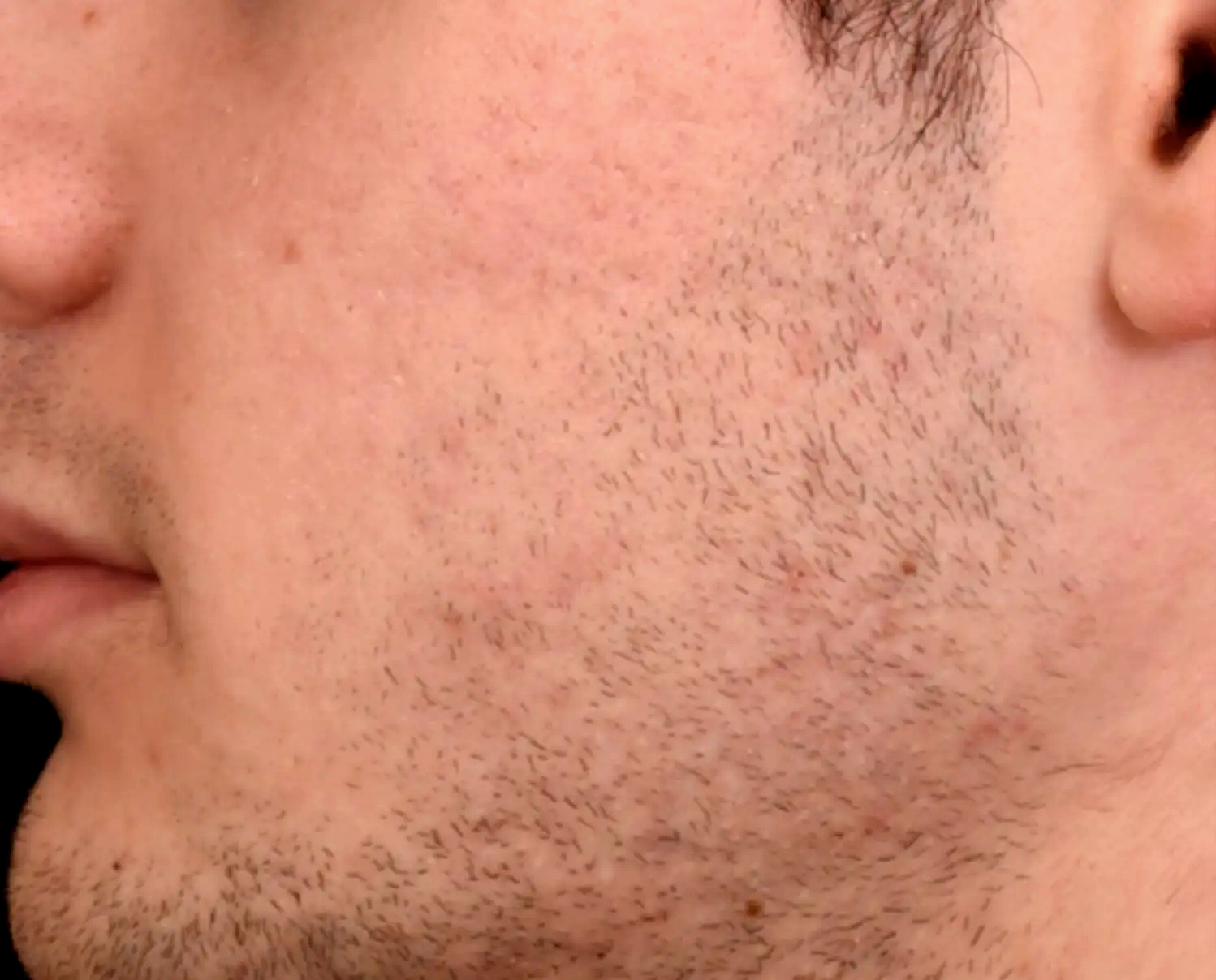 Acne-severe-cicatrices-apres-dr-barry