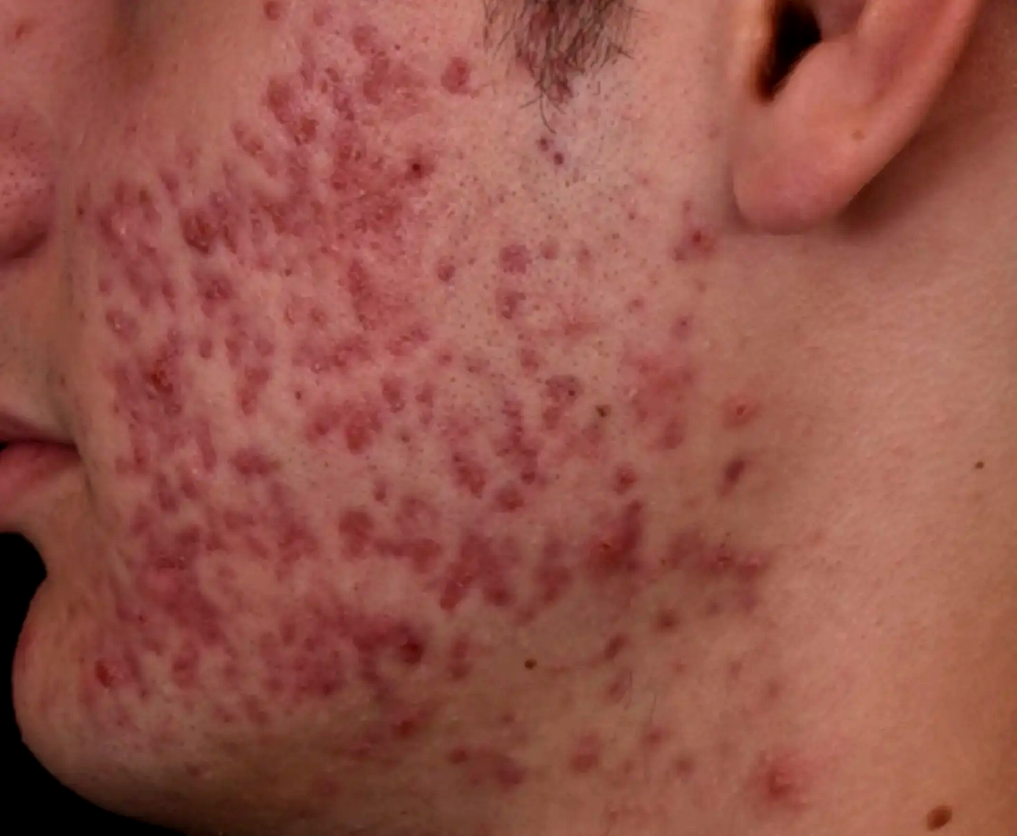 Acne-severe-cicatrices-avant-dr-barry