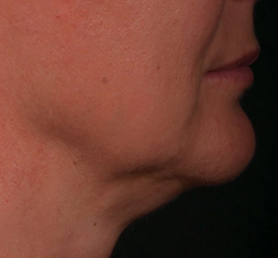 Affiner-bas-du-visage-apres-dr-barry