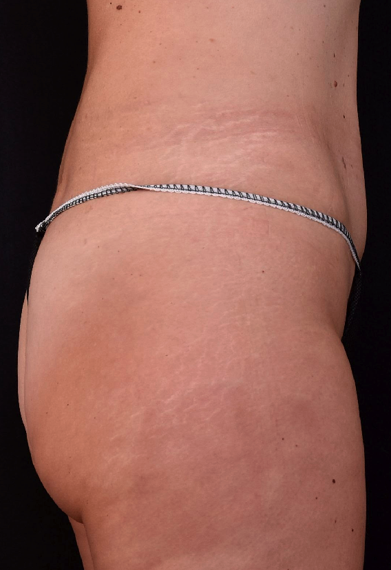 Affiner-ventre-plat-apres-dr-barry