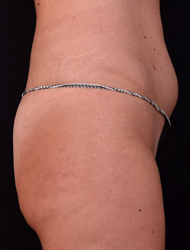 Affiner-ventre-plat-avant-dr-barry