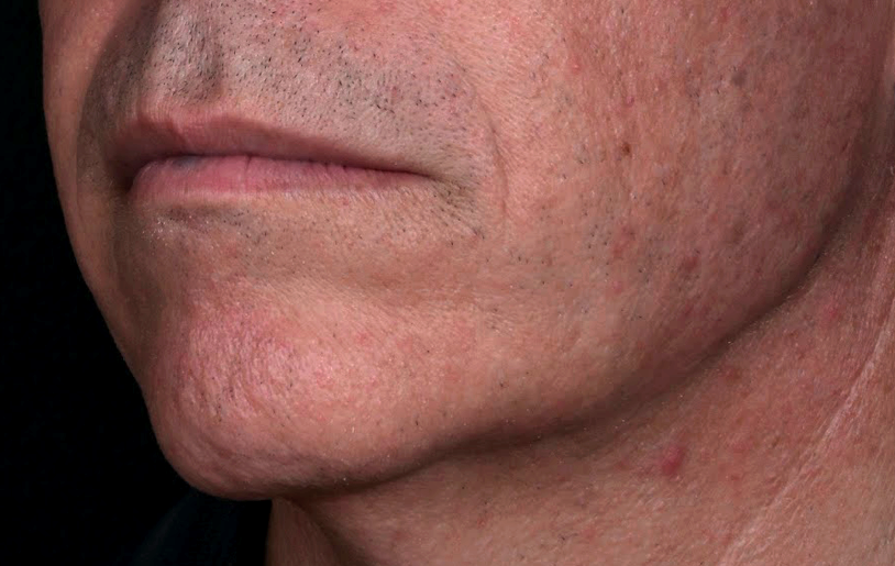 Angle-mendibulaire-homme-apres-dr-barry