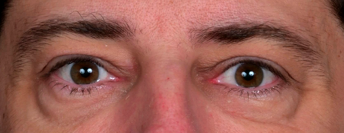 Apres-PlexR-regard-tombant-et-Xanthelasma-dr-barry