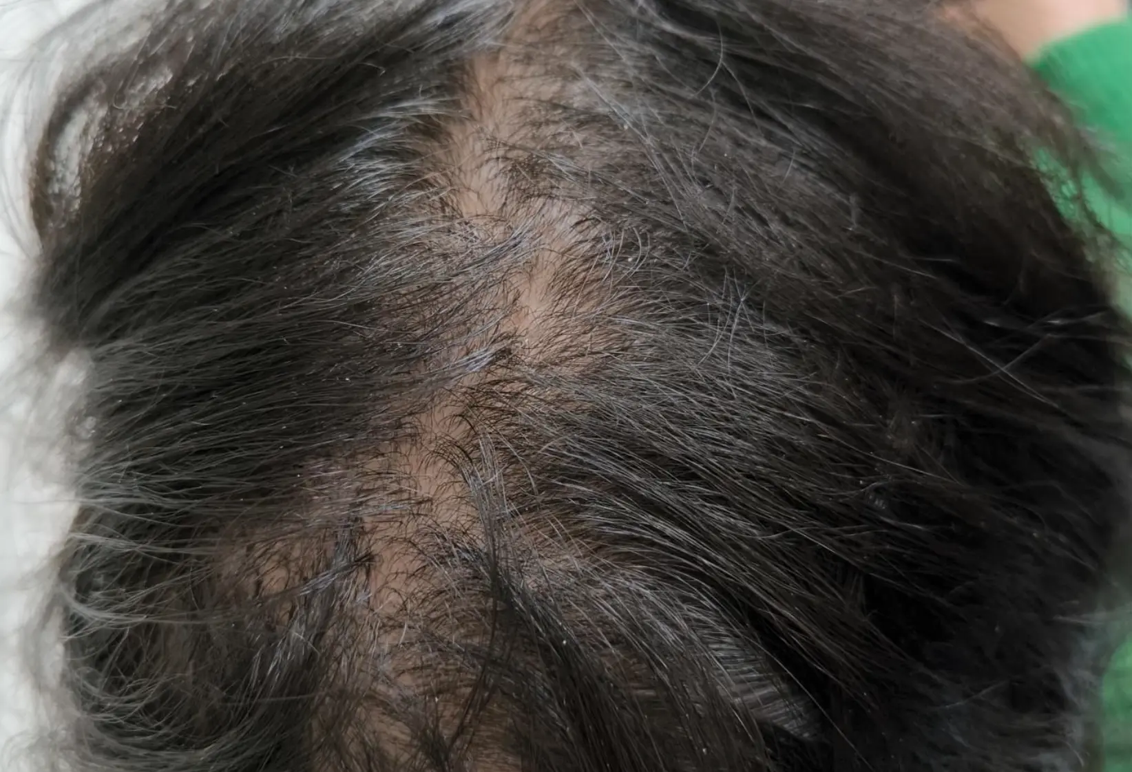 Apres-chute-cheveux-fin-terne-dr-barry