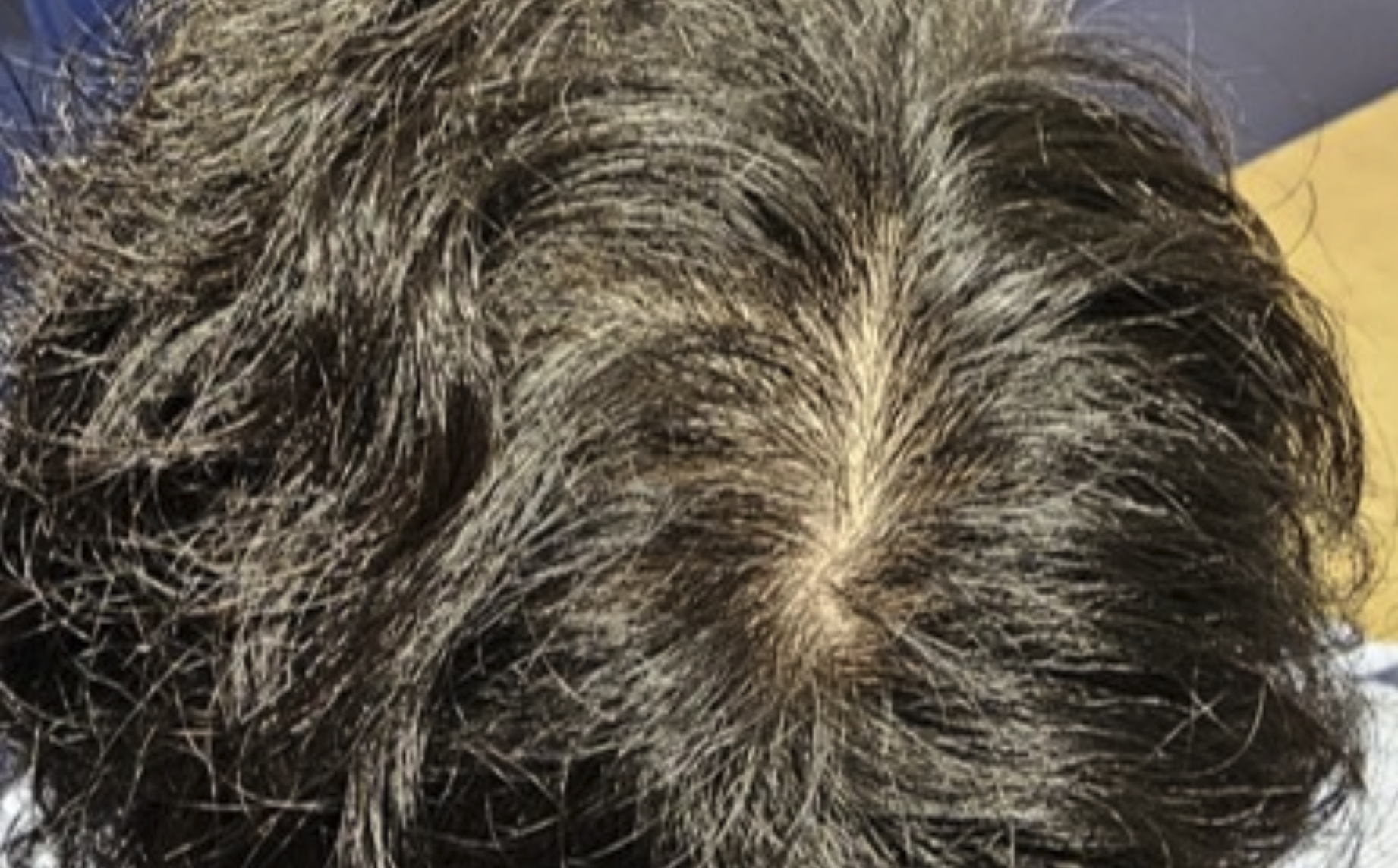 Apres-debut-alopecie-precoce-dr-barry