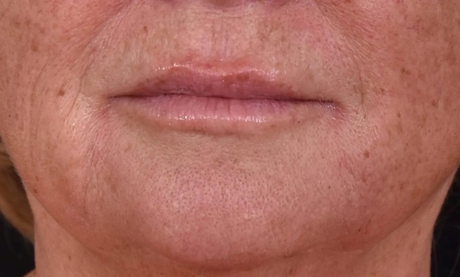 Apres-levres-affinees-perte-definition-dr-barry