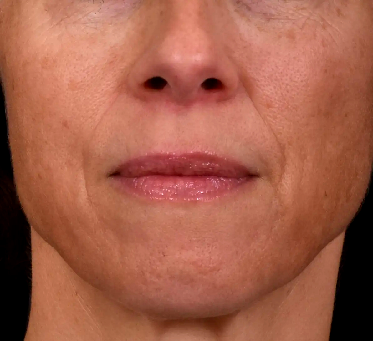 Apres-perte-de-densite-joues-dr-barry