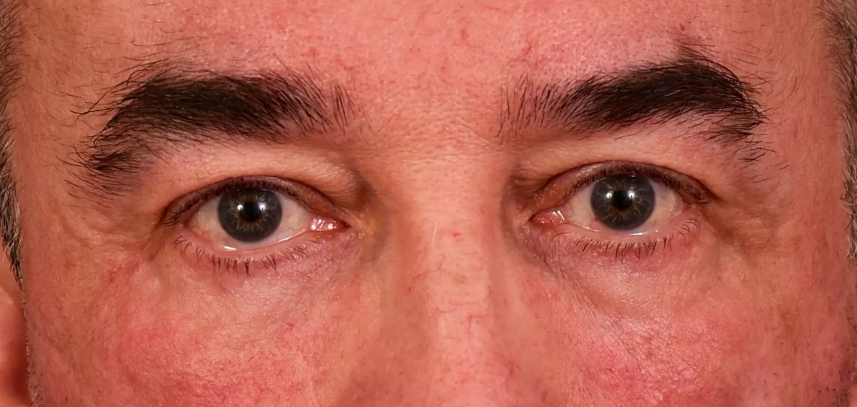 Apres-regard-fatigue-relache-poches-graisseuses-cernes-creux-sourcils-tombants-dr-barry