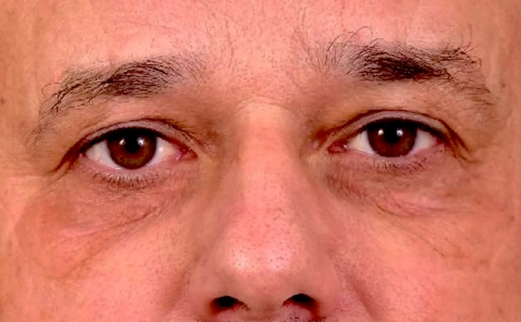 Apres-regard-triste-fatigue-paupiere-tres-relachees-colorees-dr-barry