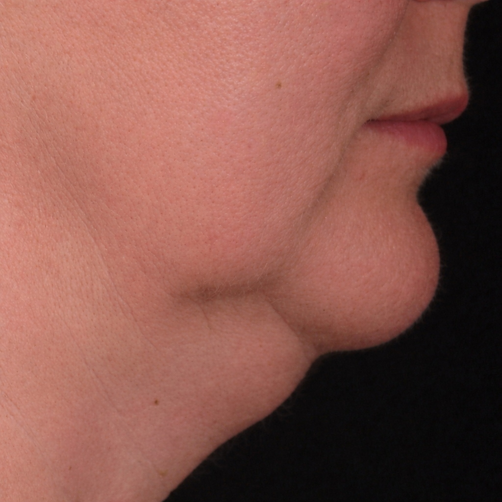 Avant-affiner-bas-du-visage-dr-barry