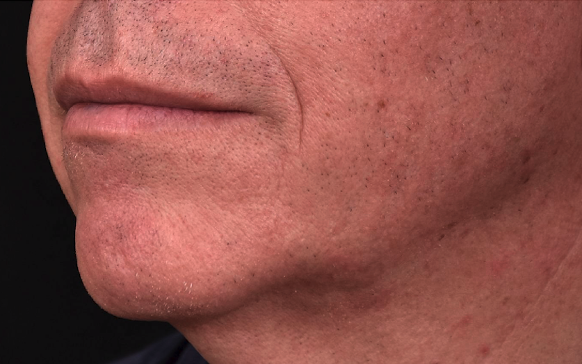 Avant-angle-mendibulaire-homme-dr-barry