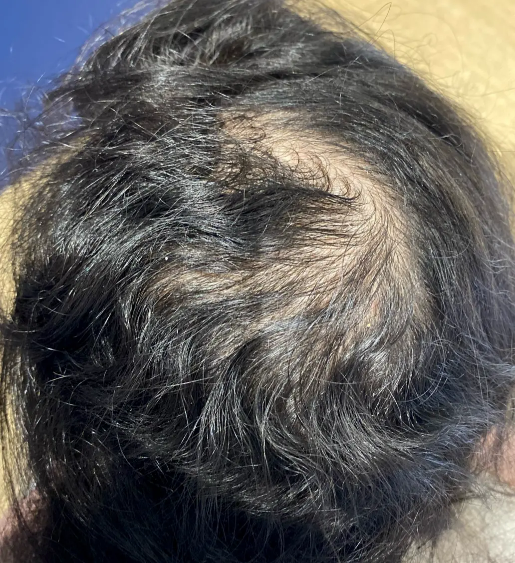 Avant-chute-cheveux-fin-terne-dr-barry