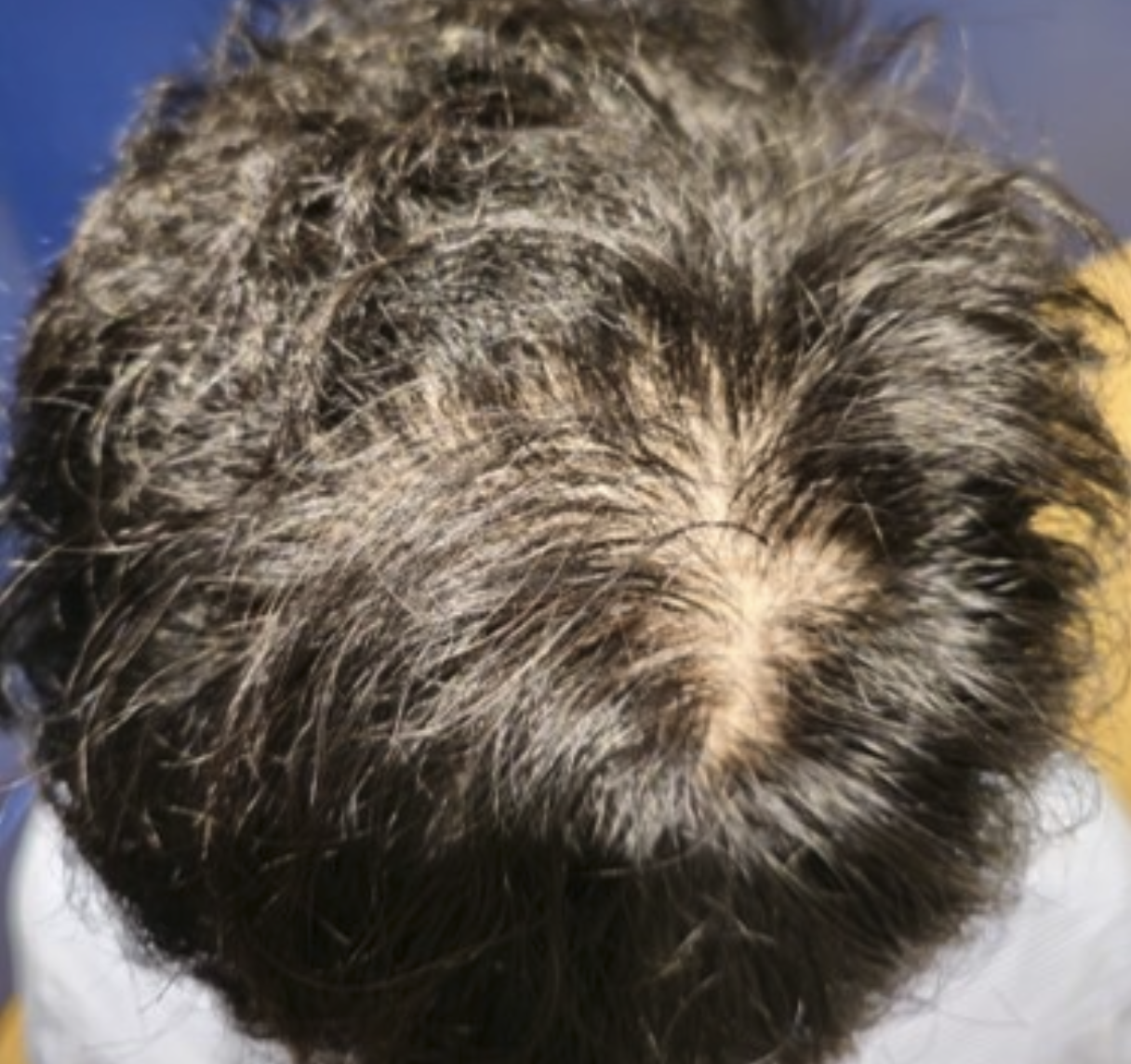 Avant-debut-alopecie-precoce-dr-barry