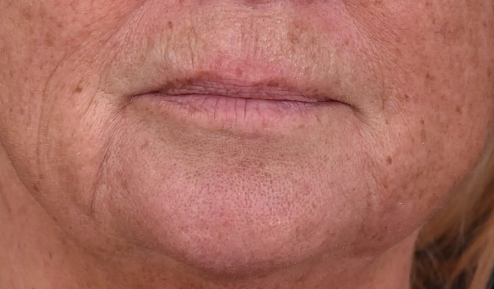 Avant-levres-affinees-perte-definition-dr-barry