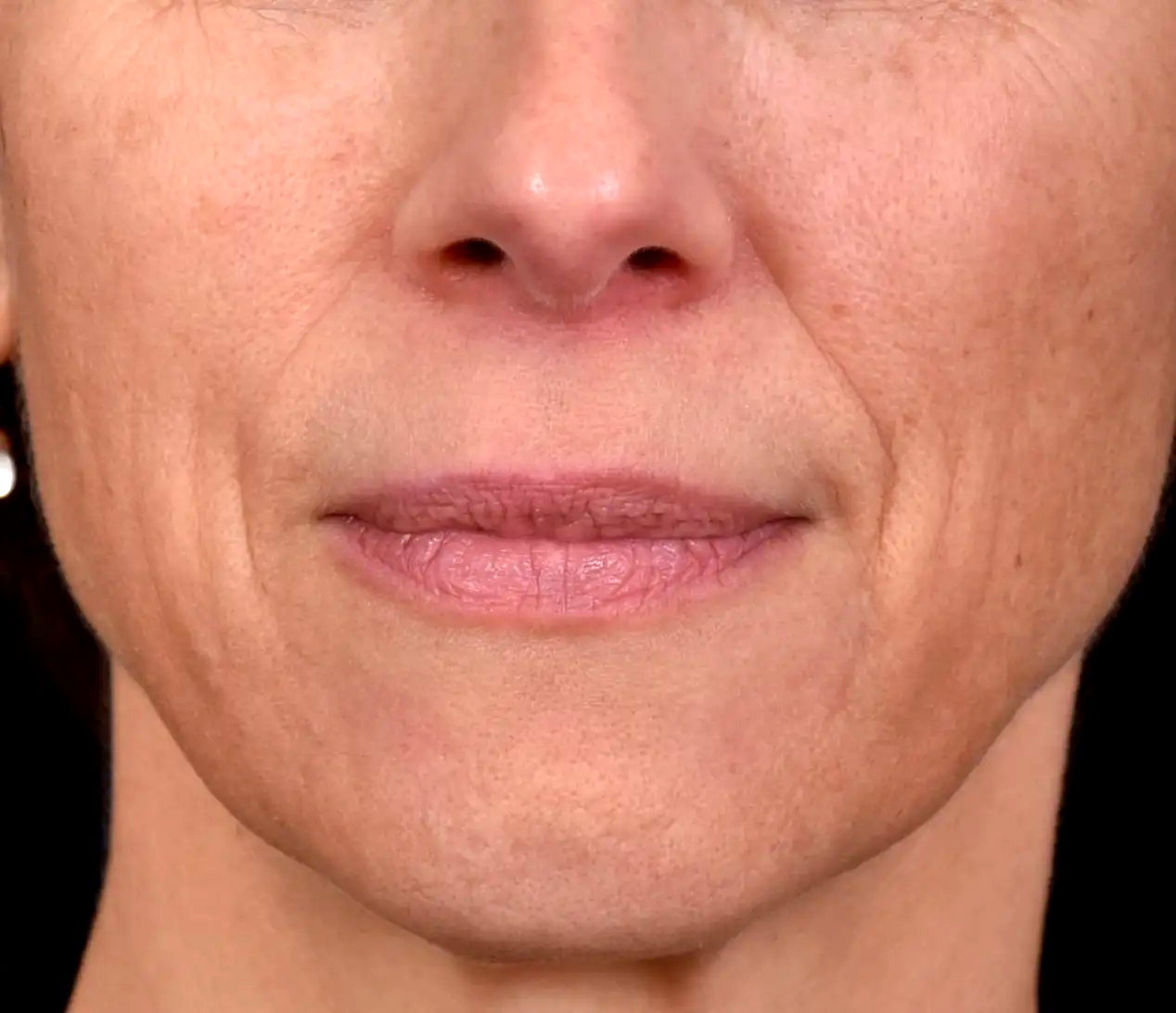 Avant-perte-de-densite-joues-dr-barry