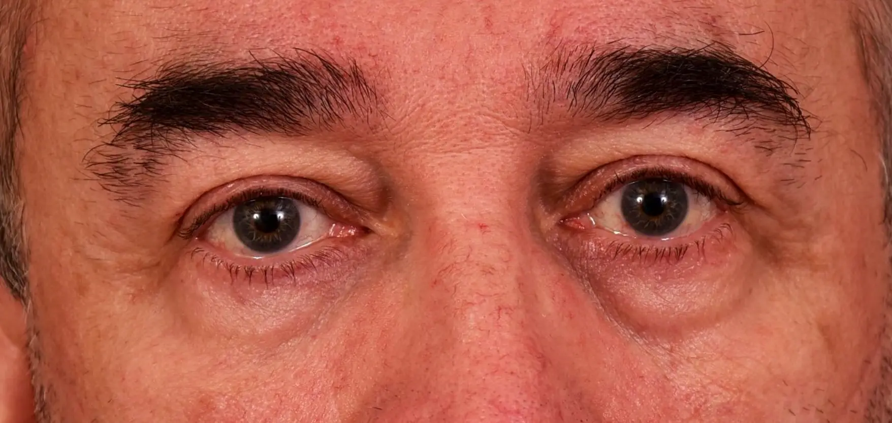 Avant-regard-fatigue-relache-poches-graisseuses-cernes-creux-sourcils-tombants-dr-barry