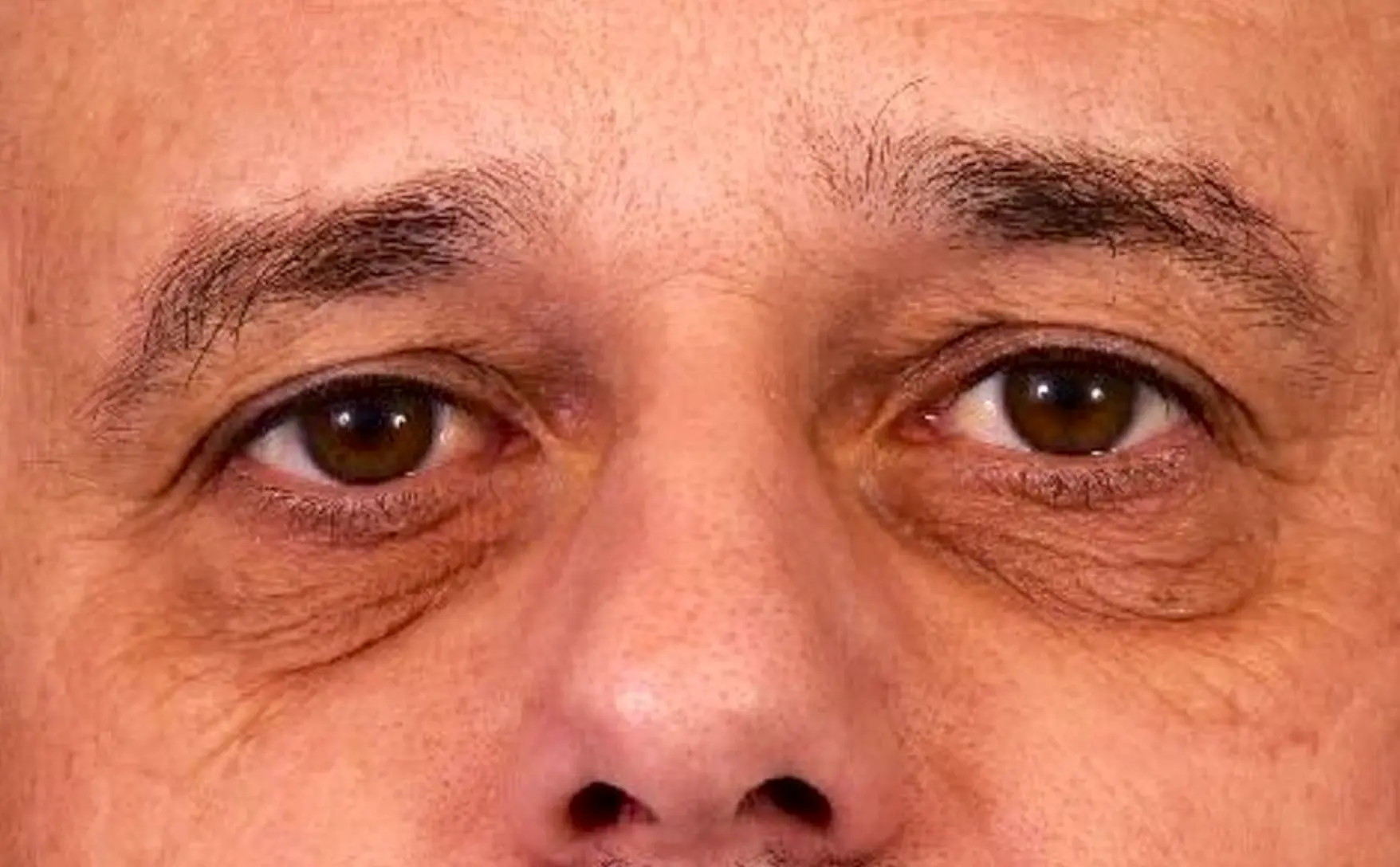 Avant-regard-triste-fatigue-paupiere-tres-relachees-colorees-dr-barry