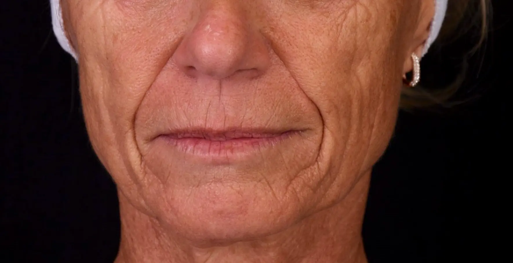 Avant-relachement-du-visage-dr-barry