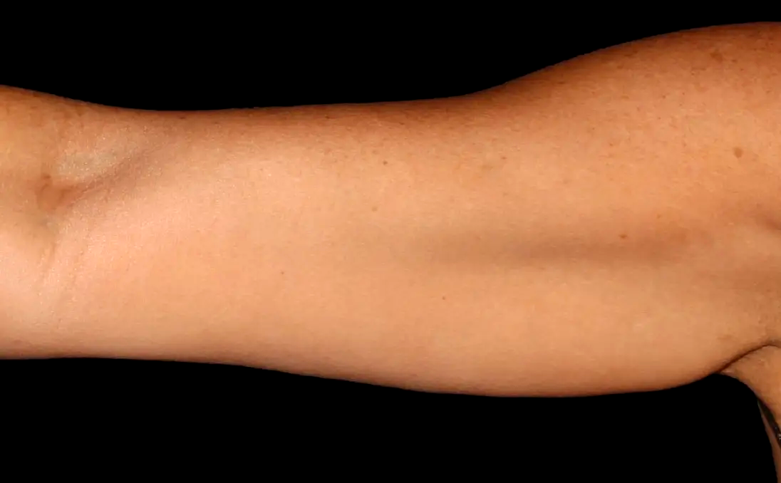 Bras-chauve-souris-apres-dr-barry