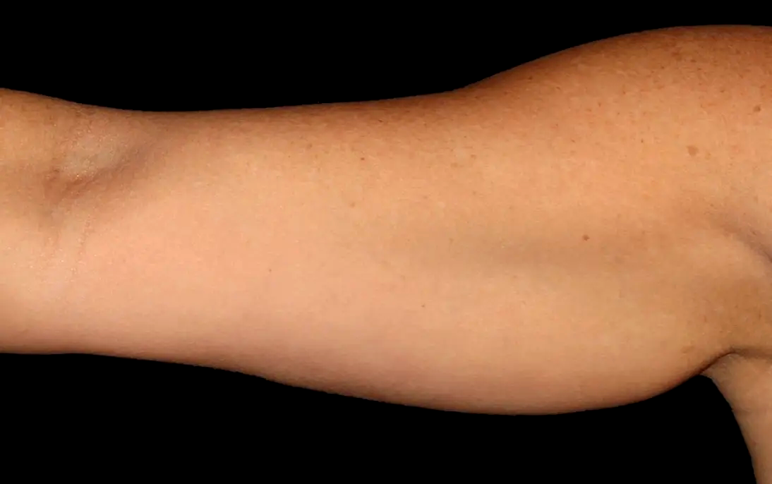 Bras-chauve-souris-avant-dr-barry