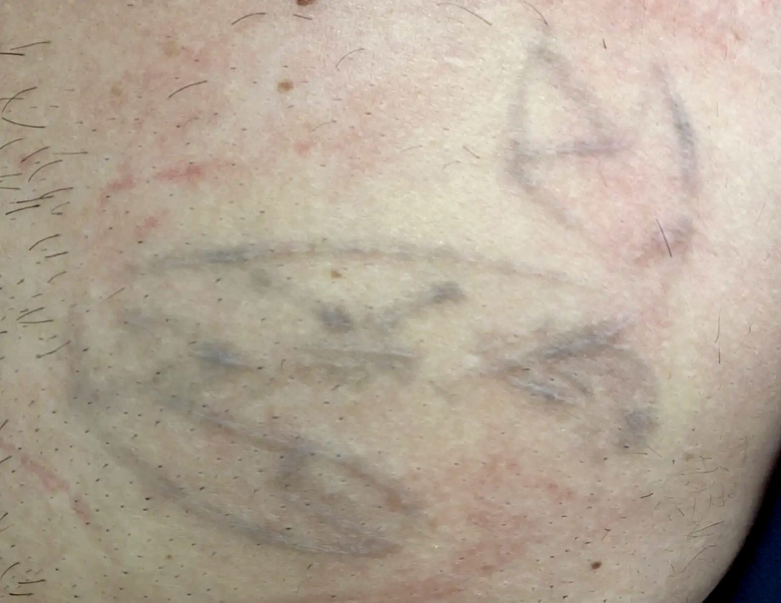 Detatouage-peau-apres-dr-barry