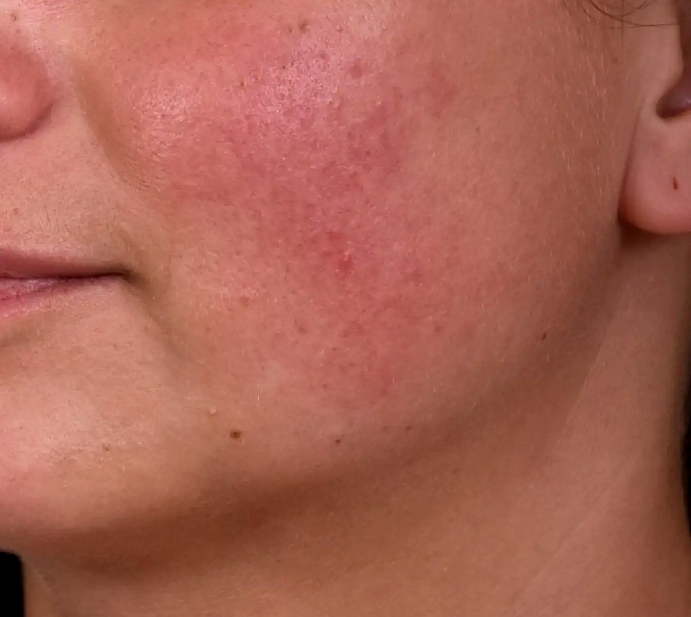 Kleresca-rosacee-apres-dr-barry