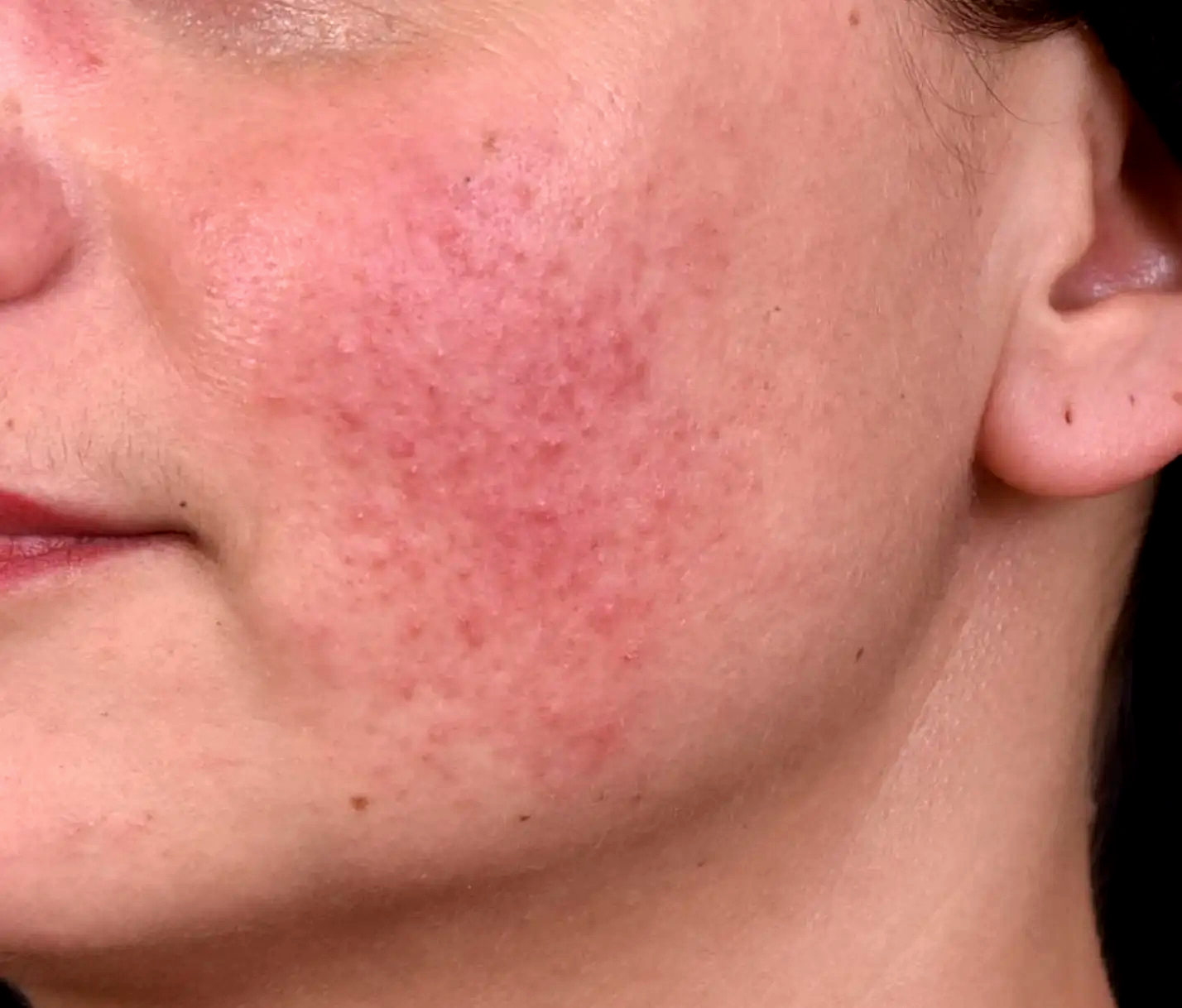 Kleresca-rosacee-avant-dr-barry