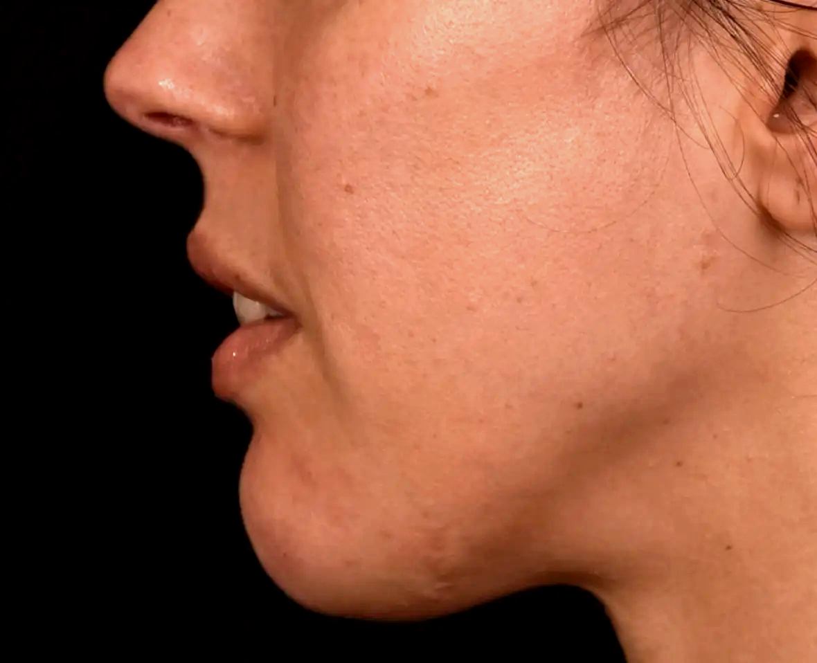 Menton-retru-apre-dr-barry