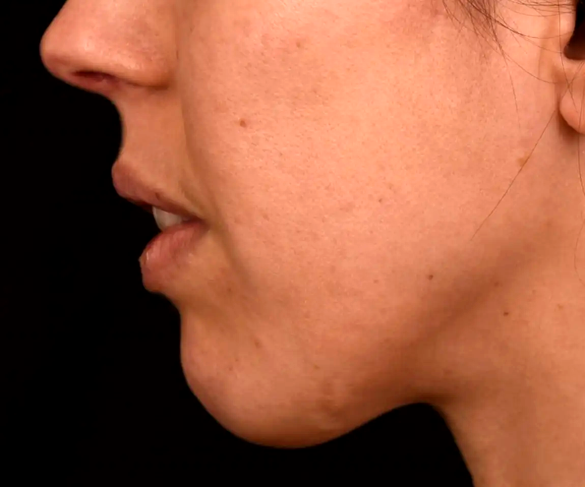 Menton-retru-avant-dr-barry