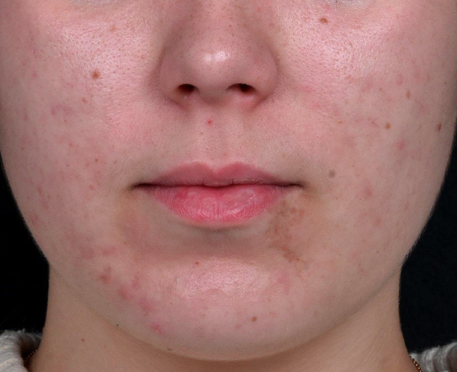 Nettoyage-de-peau-medical-LED-peelings-apres-dr-barry