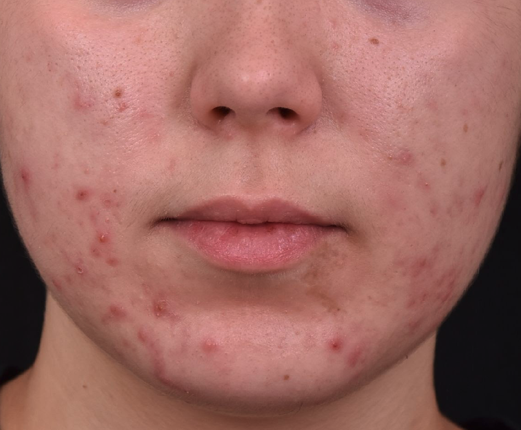 Nettoyage-de-peau-medical-LED-peelings-avant-dr-barry