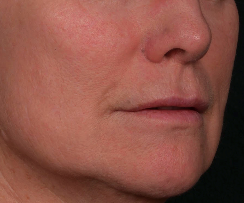 Peeling-moyen-apres-dr-barry