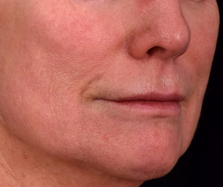 Peeling-moyen-avant-dr-barry