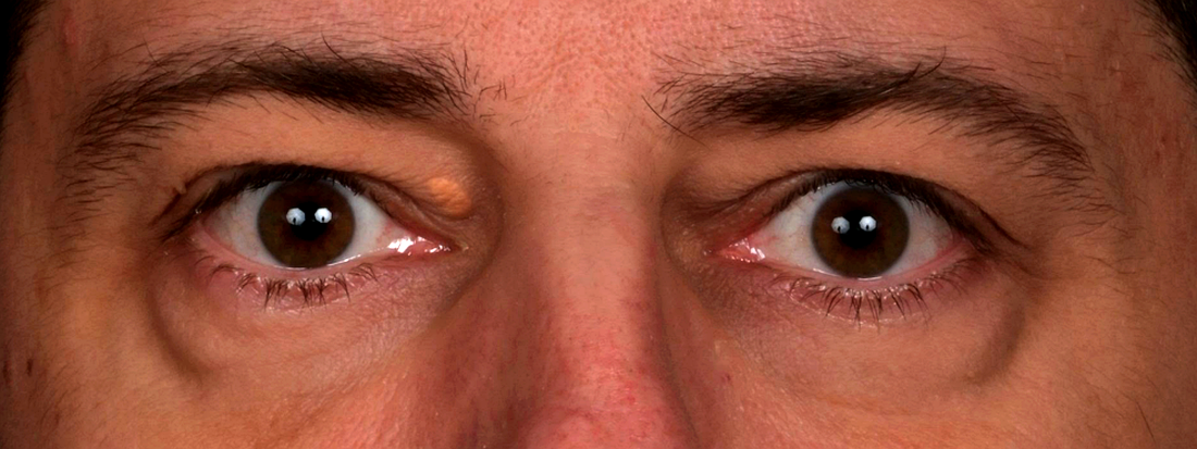 PlexR-regard-tombant-et-Xanthelasma-avant-1-dr-barry