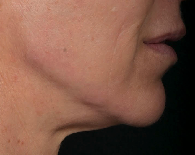 Redefinition-ligne-mandibulaire-apres-dr-barry