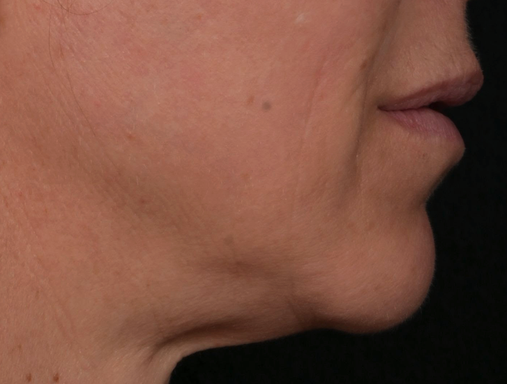 Redefinition-ligne-mandibulaire-avant-dr-barry