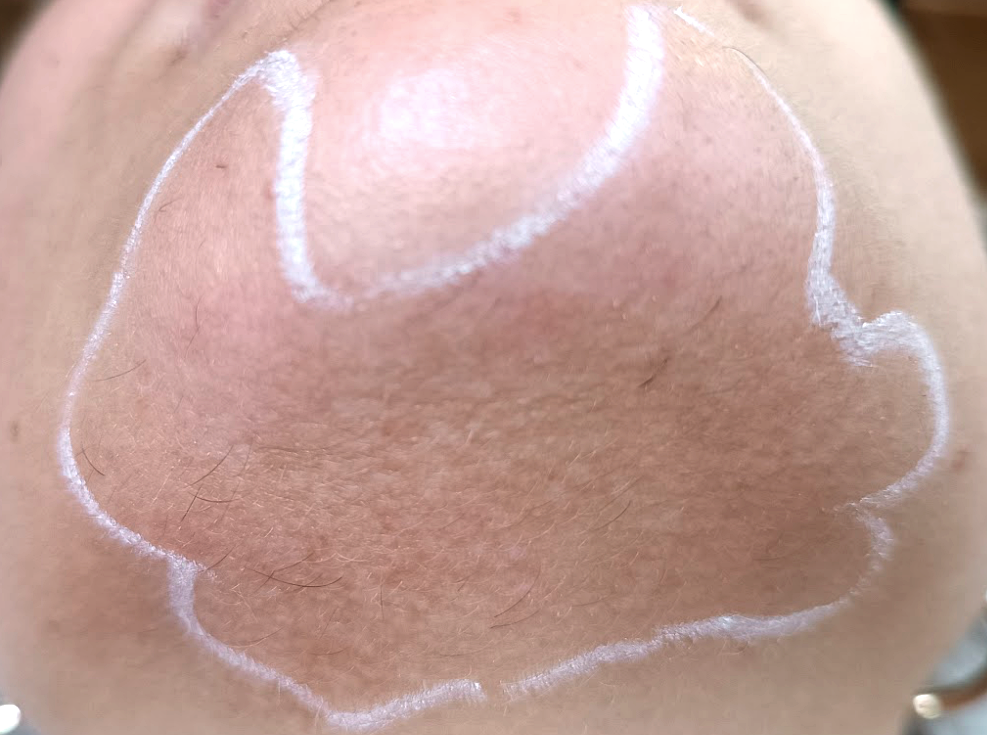 Reduction-pilosite-menton-apres-dr-barry