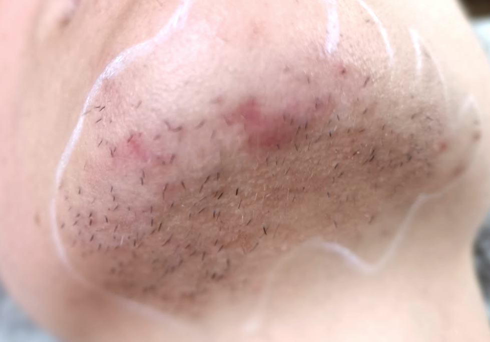 Reduction-pilosite-menton-avant-dr-barry