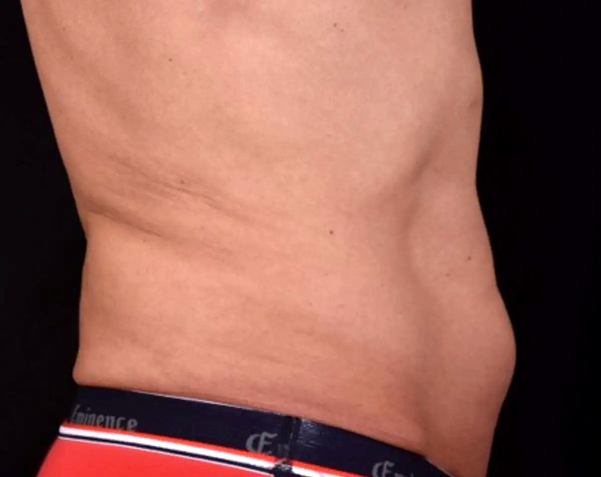 Resistance-malgre-le-sport-avant-dr-barry