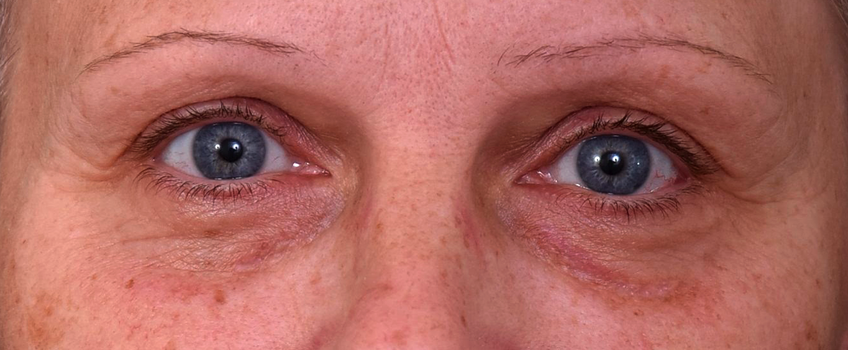Retrait-du-xanthelasma-apres-dr-barry