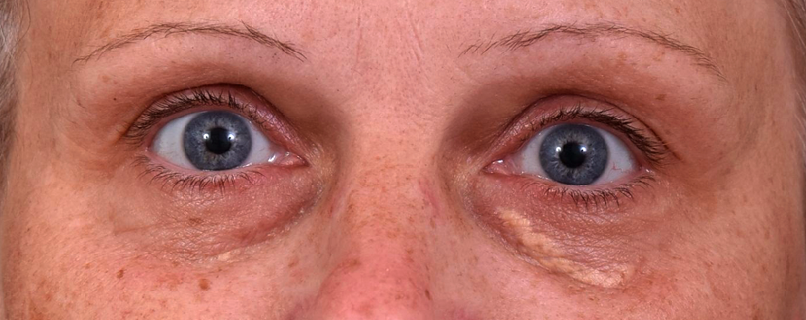 Retrait-du-xanthelasma-avant-dr-barry