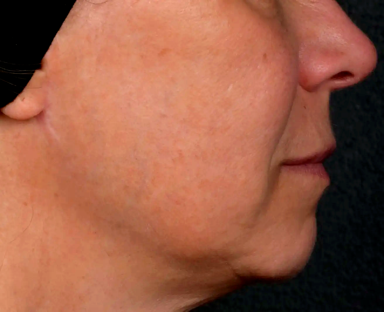 Teint-terne-peau-Apres-dr-barry