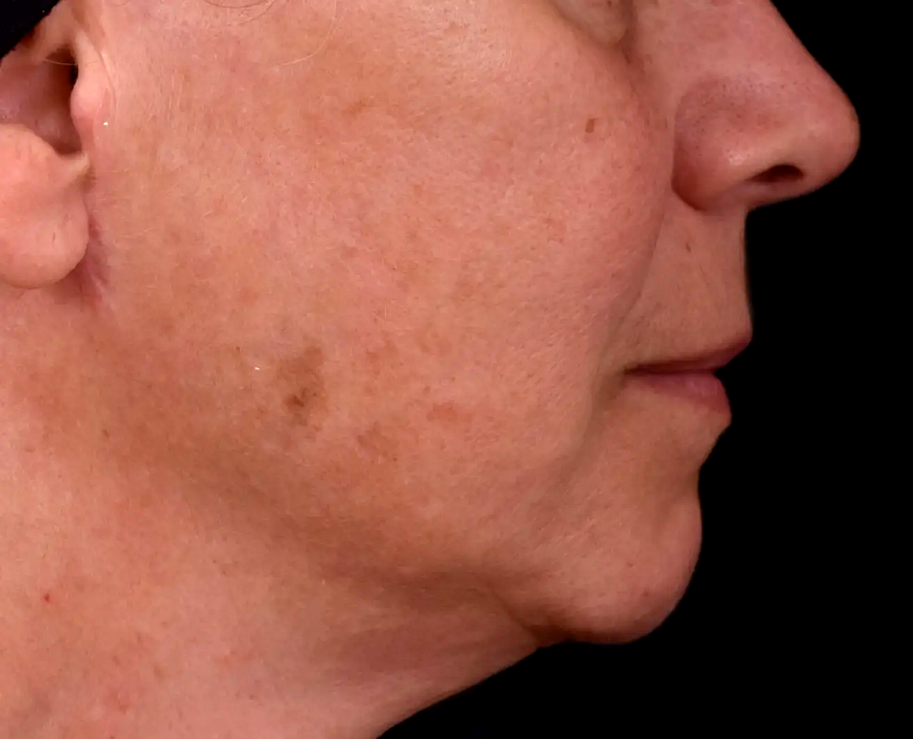 Teint-terne-peau-Avant-dr-barry