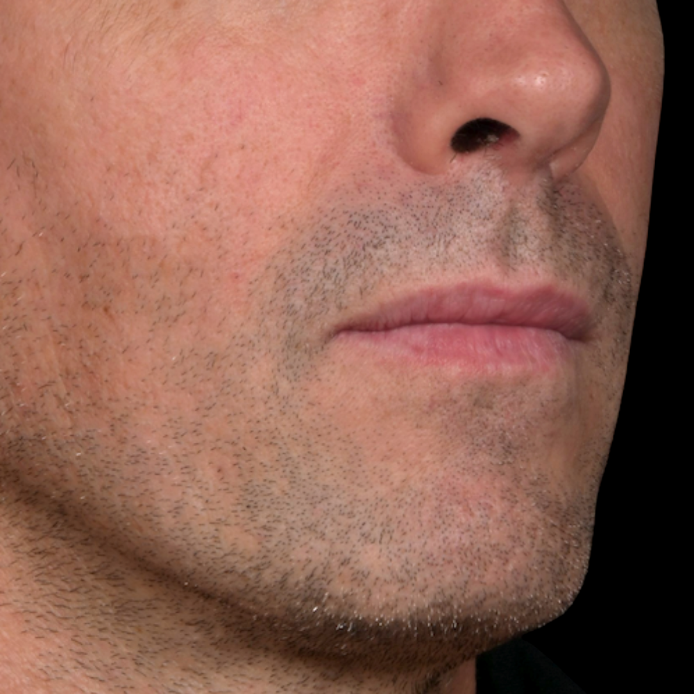 apres-comblement-joues-creuses-dr-barry