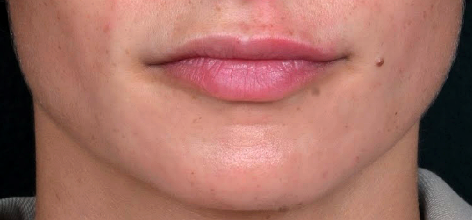 apres-corriger-levres-fines-asymetriques-dr-barry