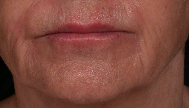 apres-injection-bouche-ah-dr-barry