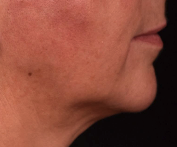 apres-menton-retru-dr-barry