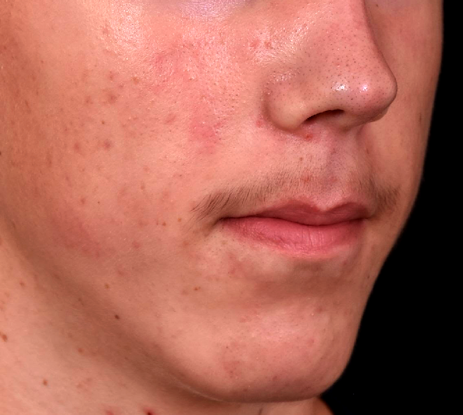 apres-traitement-acne-adolescent-dr-barry